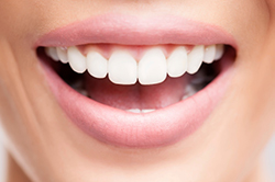 A smiling woman after her gum lift surgery at United Smile Centres, in Louisville, KY.