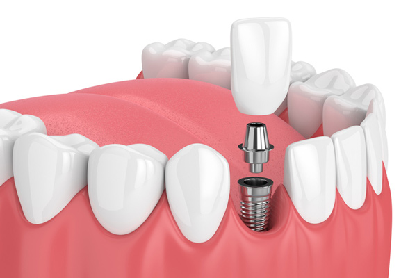 Diagram of a single dental implant.