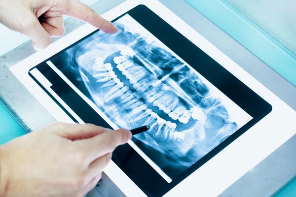 An X-ray of a full mouth needing restoration at United Smile Centres in Louisville, KY