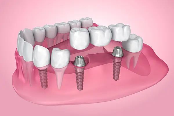 A diagram showing how a dental bridge is supported by two implants placed in the jaw.